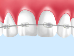 自然で目立たない矯正ができる！